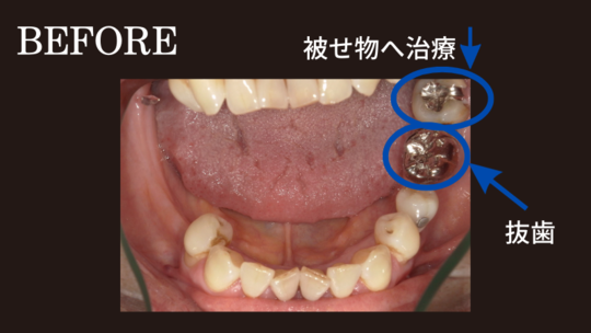 チタン床義歯の部分入れ歯の症例「お口の中全体を治したい」 - 秦野市入れ歯専門歯科外来